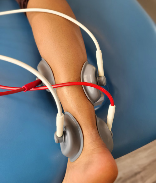 Patient receiving IFC treatment for Achilles 
