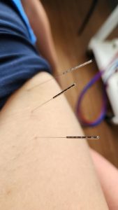 3 acupuncture needles in a female patients upper thigh.