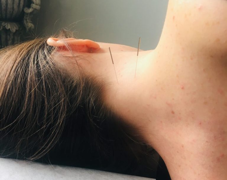 Person having an acupuncture treatment