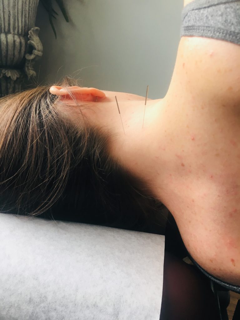 A female patient receiving acupuncture treatment for neck pain