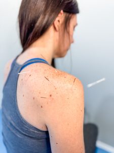 shoulder acupuncture oakville