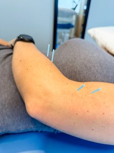 acupuncture treatment for tennis elbow 