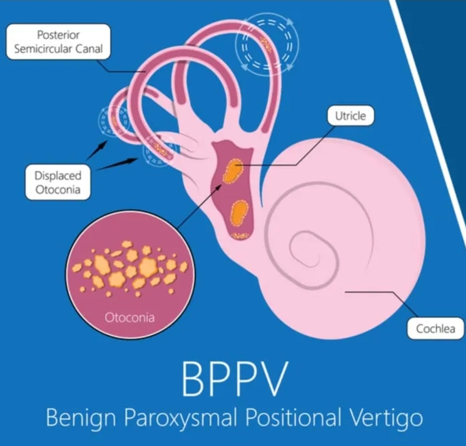 A graphic showing BPPV treatment 