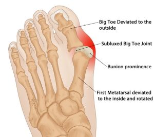 anatomy of a bunion, showing the big toe move inward and causing pain