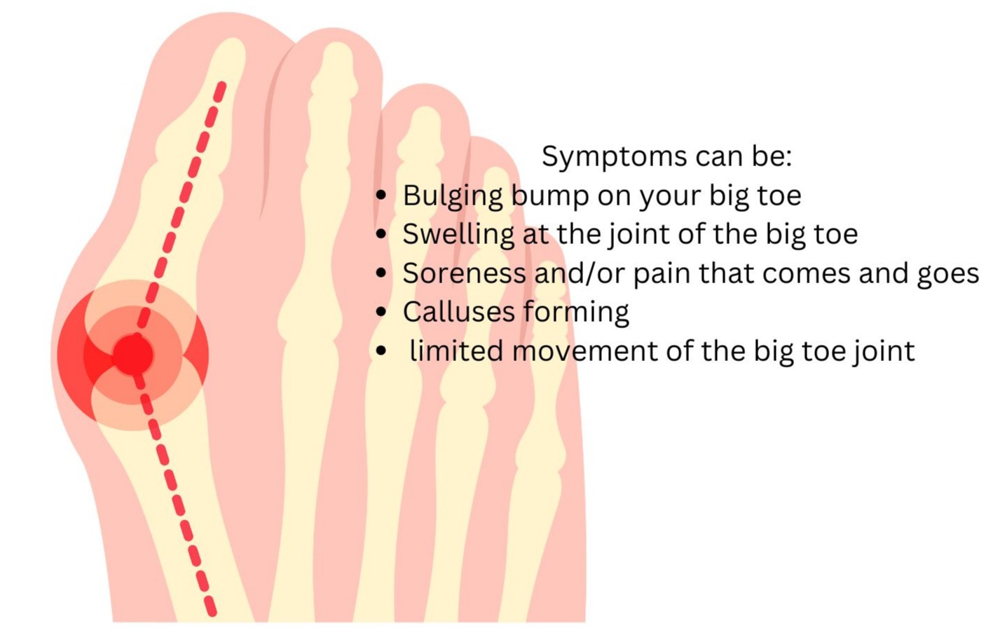 A graphic showing bunion symptoms 