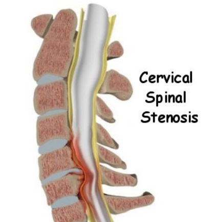 A graphic showing cervical spinal stenosis