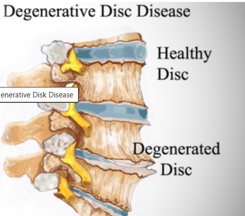 A graphic showing degenerative disc disease 