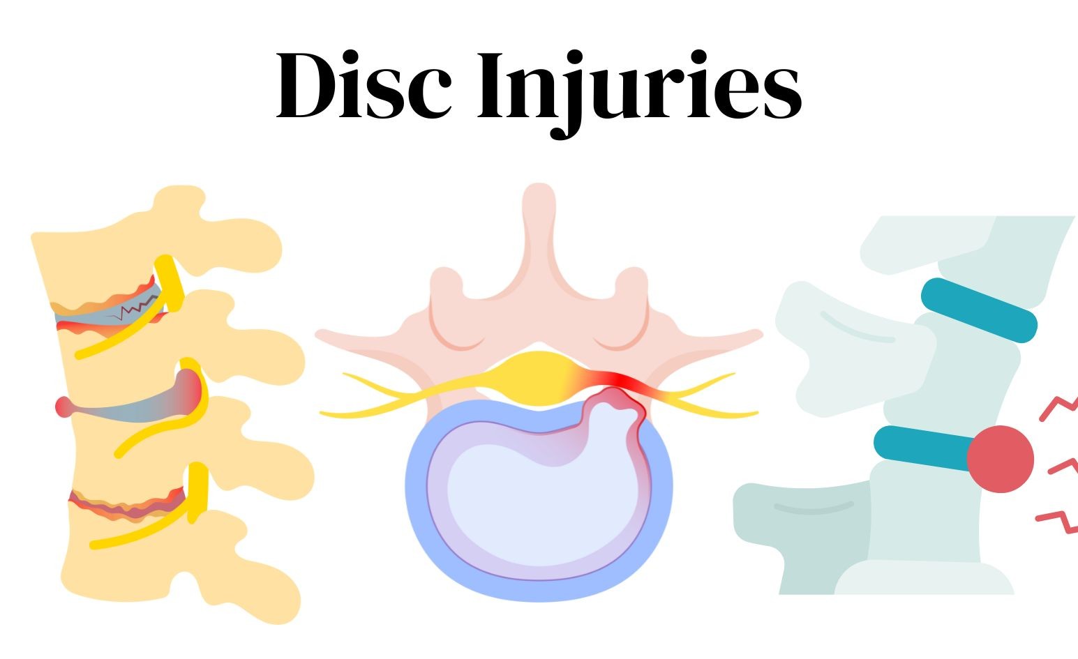 A graphic showing Disc disruption/herniation