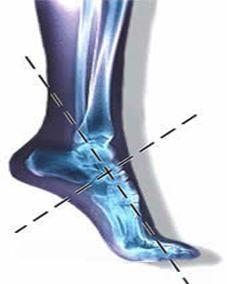 poor foot posture