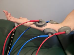 suction ifc unit on a patients elbow