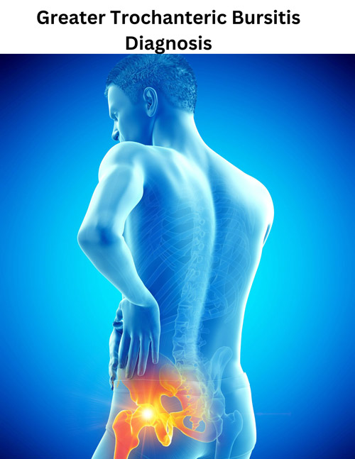 A graphic showing Greater Trochanteric Bursitis pain area