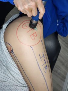 A shockwave gun being used on patient to treat GTB at Oakville clinic