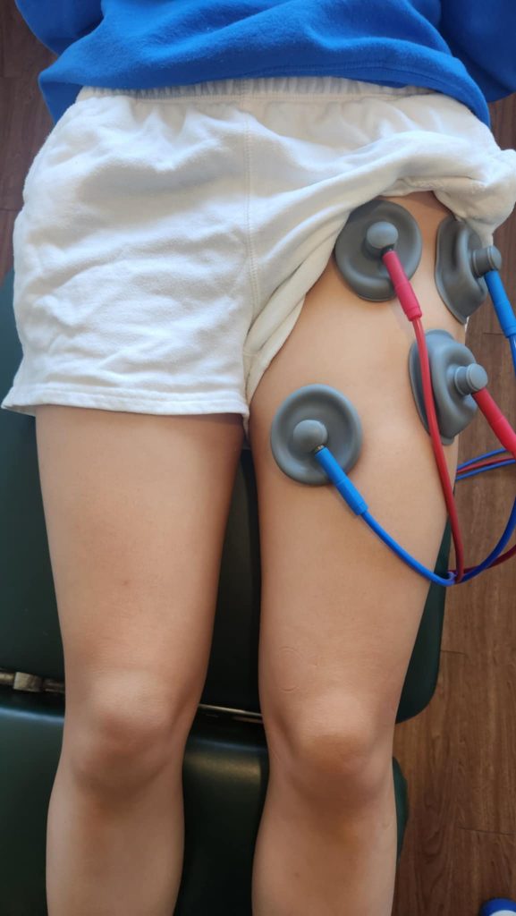 suction ifc machine on a patients front hip. 4 suction cups with 2 red and 2 blue lines