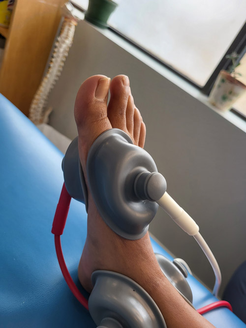 IFC treatment being performed on foot for Morton's Neuroma