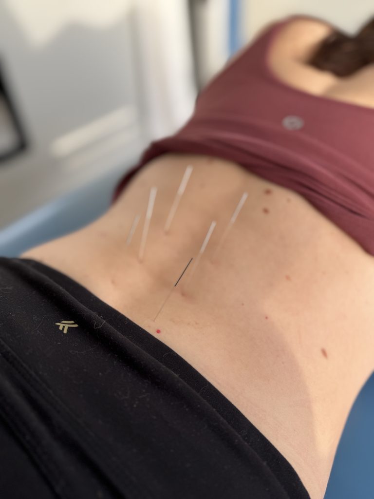 acupuncture for lower back pain side profile of needles