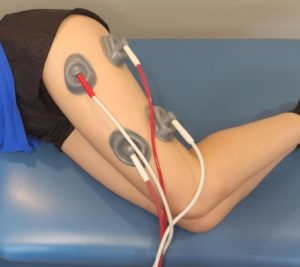 IFC machine on the side of a patients upper leg helping IT band syndrome