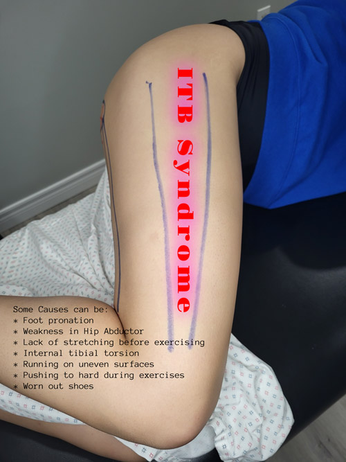 A picture showing symptoms of ITB syndrome