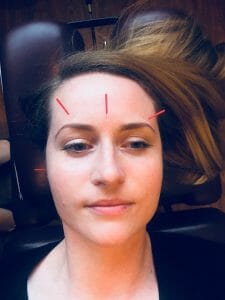 Acupuncture near me. Acupuncture pain treatment.