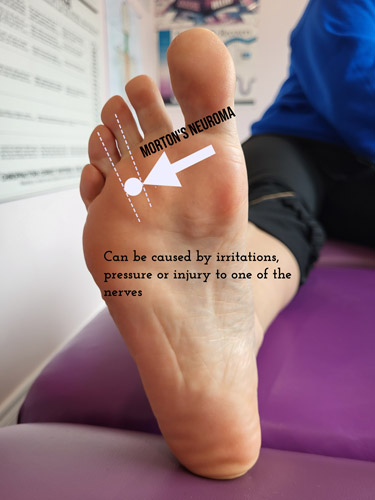 A graphic showing a foot with marks on, explaining what causes Morton Neuroma
