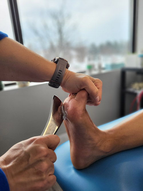 A picture showing morton's neuroma treatment using instrument assisted soft tissue therapy