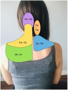 a diagram of the nerve injuries that could occur in the neck