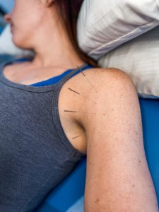 acupuncture for bicep tendonitis