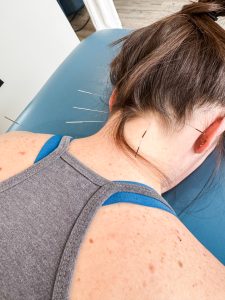 acupuncture for migraines in oakville