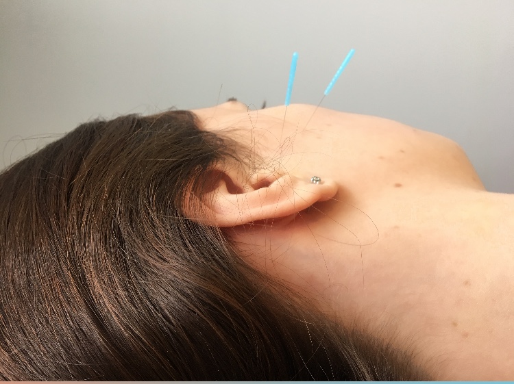 oakville acupuncture tmj treatment