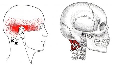 oakville chiropractor suboccipital pain