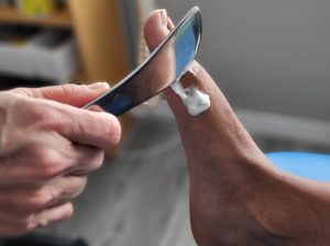 a metal tool being used as a physiotherapy aid on a patients bunion