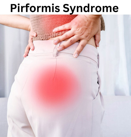 A graphic showing pain areas of Piriformis Syndrome