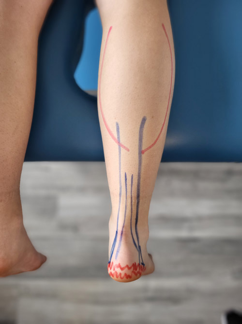 A picture showing pain areas of plantar fasciitis and calf