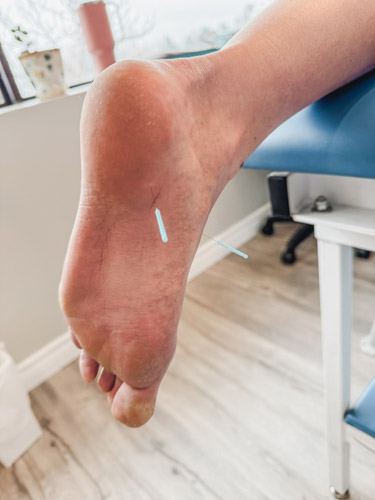 Patient receiving acupuncture treatment for planter fasciitis