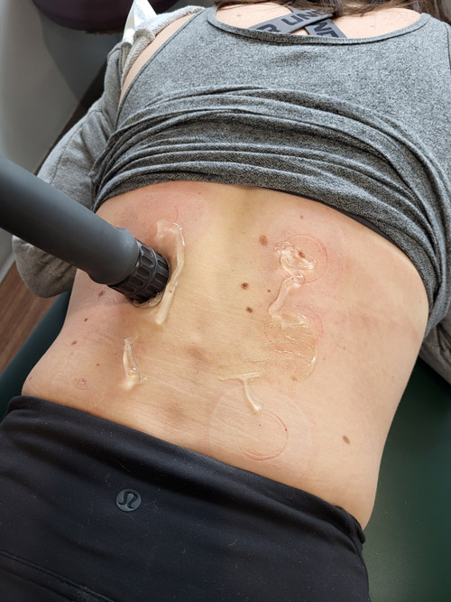 A patient receiving shockwave treatment for Quadratus lumborum