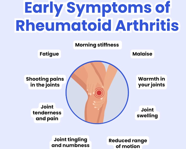 A graphic showing early symptoms of rheumatoid arthritis