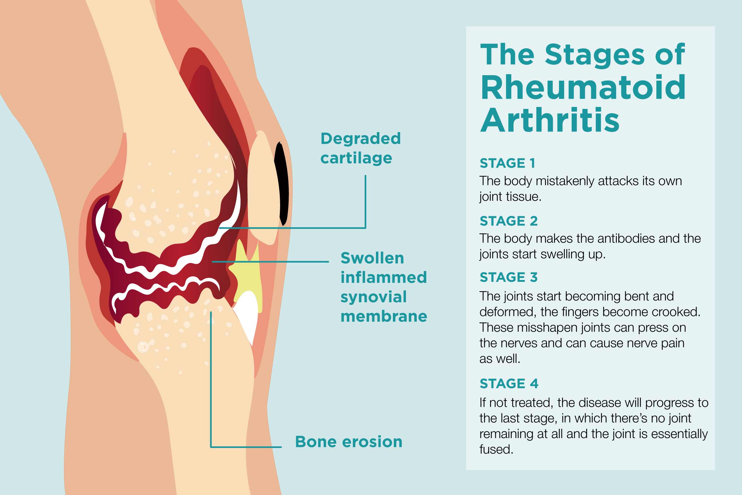 A graphic showing treatments of rheumatoid arthritis