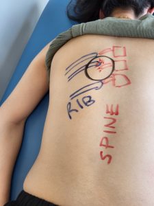 drawing of a spine on a patients back with a mark over where the rib pain would be felt, behind the shoulder blade