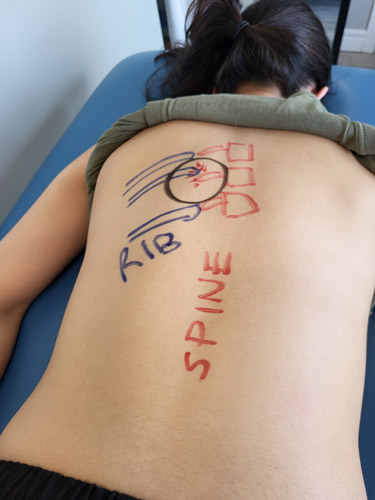 A picture showing marks on back, depicting cause of rib pain 