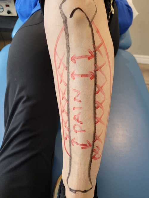 A picture showing marks on leg with marker, to show the areas effected by Shin Splint