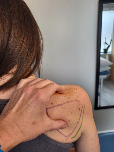 Doctor marked on patient's shoulder for shoulder pain