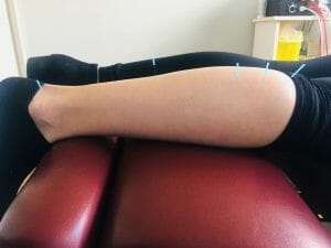Acupuncture near me. Acupuncture pain treatment.