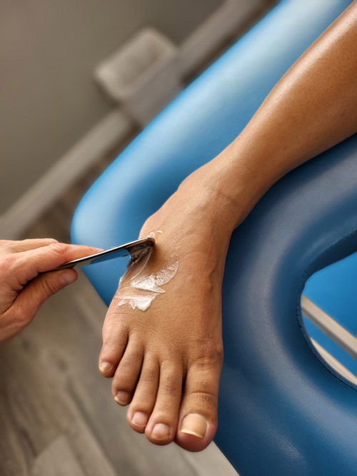 Instrumental assisted soft tissue treatment being performed on foot for sinus tarsi