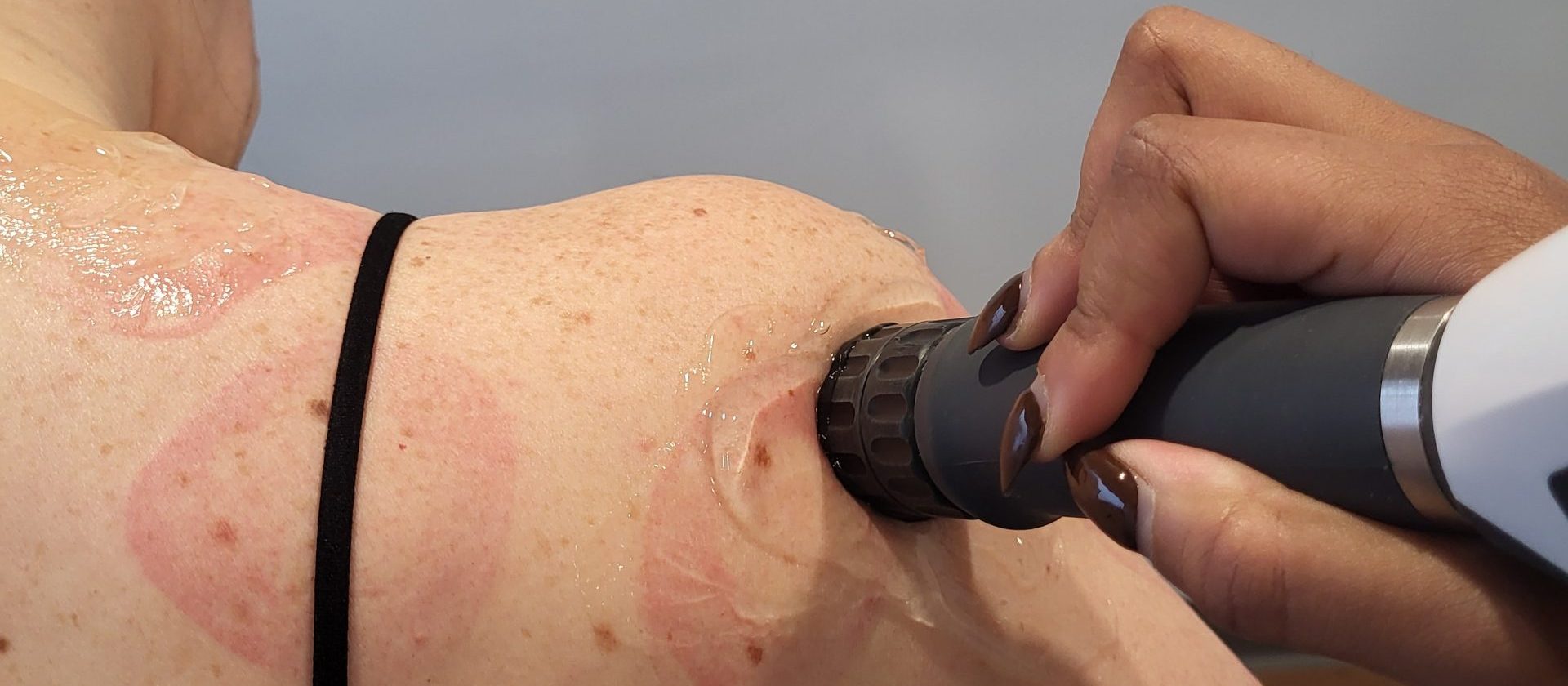 Oakville Shockwave Therapy