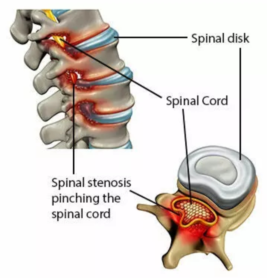 A graphic showing Spinal Stenosis Degenerative Changes