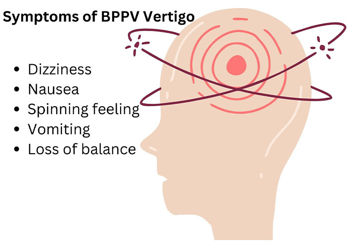 A graphic showing symptoms of BPPV