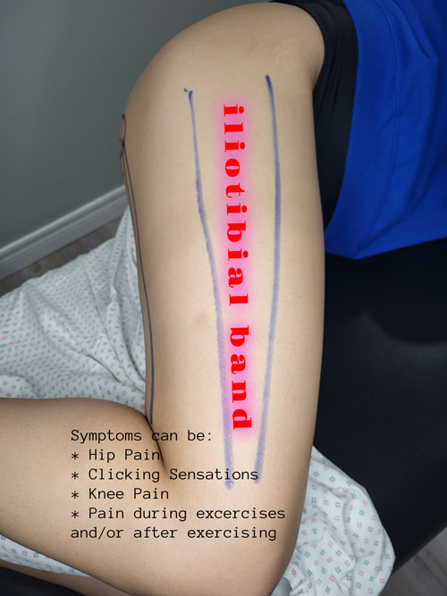 A picture showing symptoms of ITB syndrome