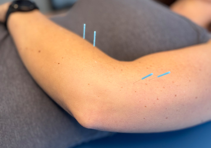 A patient receiving acupuncture treatment for elbow pain