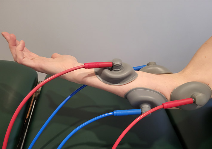 Interferential Current Therapy being given to patient for elbow pain