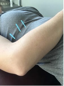 Acupuncture near me. Acupuncture pain treatment.