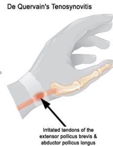 drawing of De Quervain's syndrome on the outside of the where the thumb meets the wrist.
